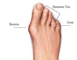 Toe overlapping and deformation